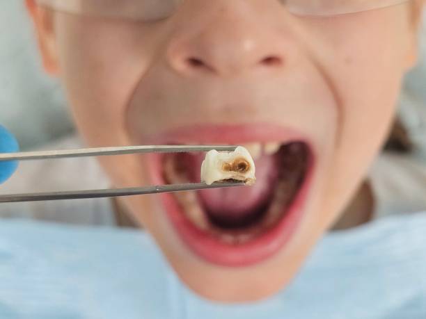 Best Emergency Root Canal Treatment in Lexington Park, MD